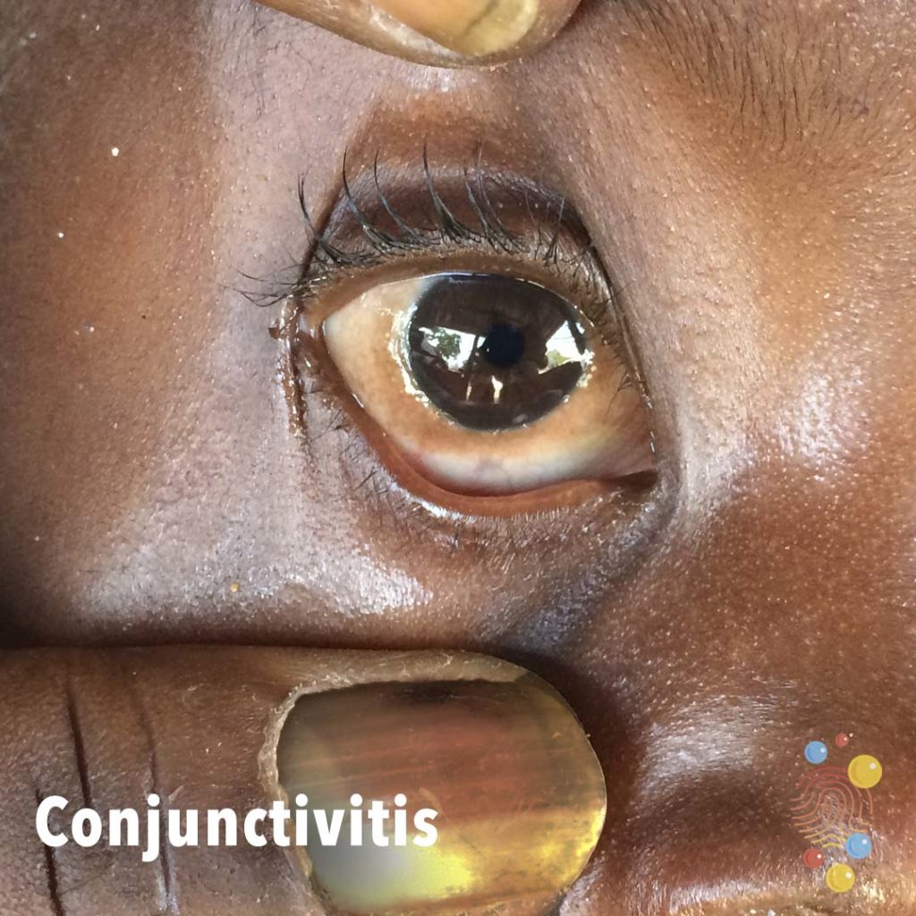 Conjunctivitis-beyond the bubbles.jpg